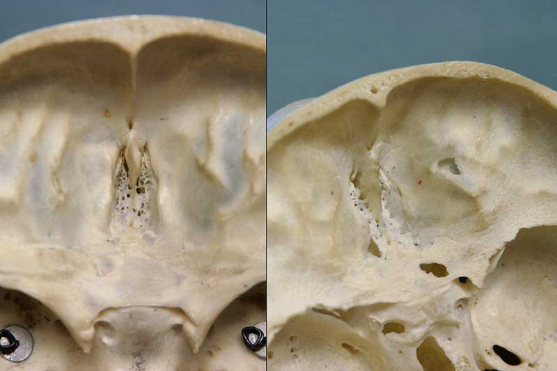 ethmoid bone in skull